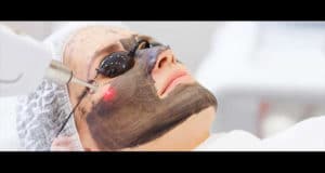 Hollywood peel